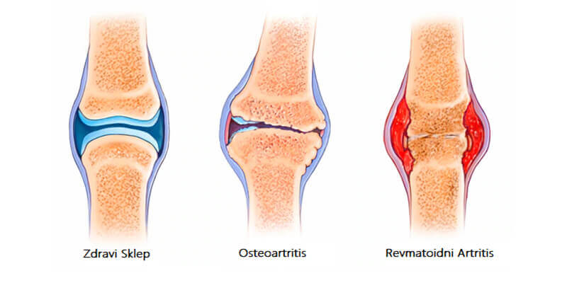 vrste artritisa