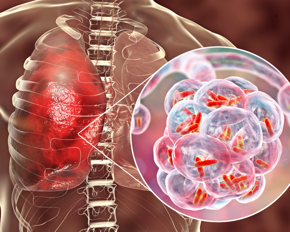pljučnica rentgen pljuč