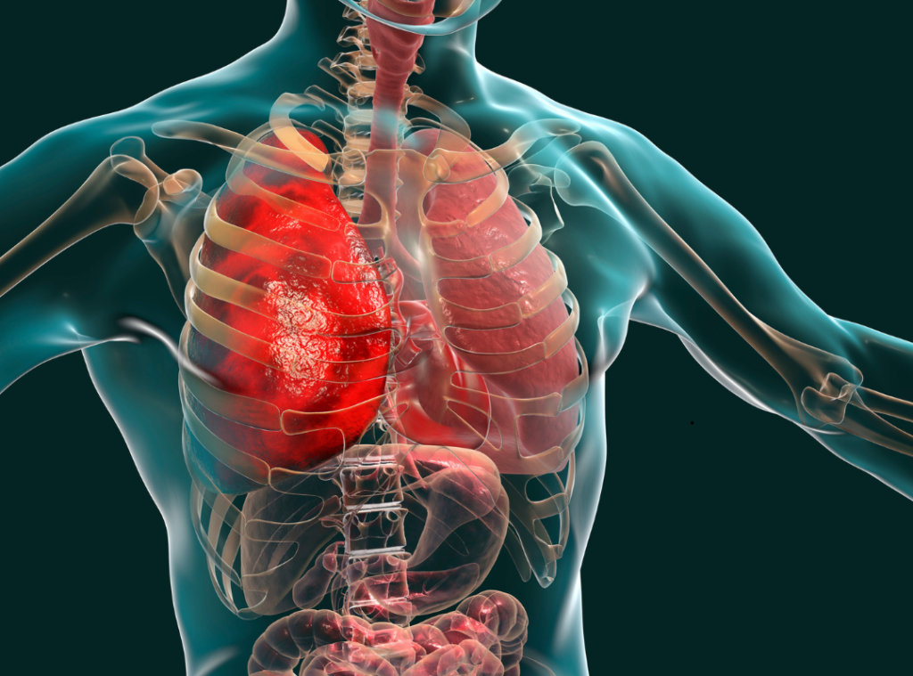 pljučnica - poškodovana pljuča