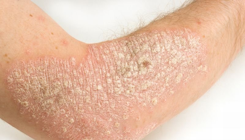kontaktni dermatitis