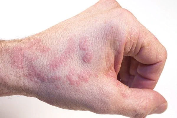atopijski dermatitis