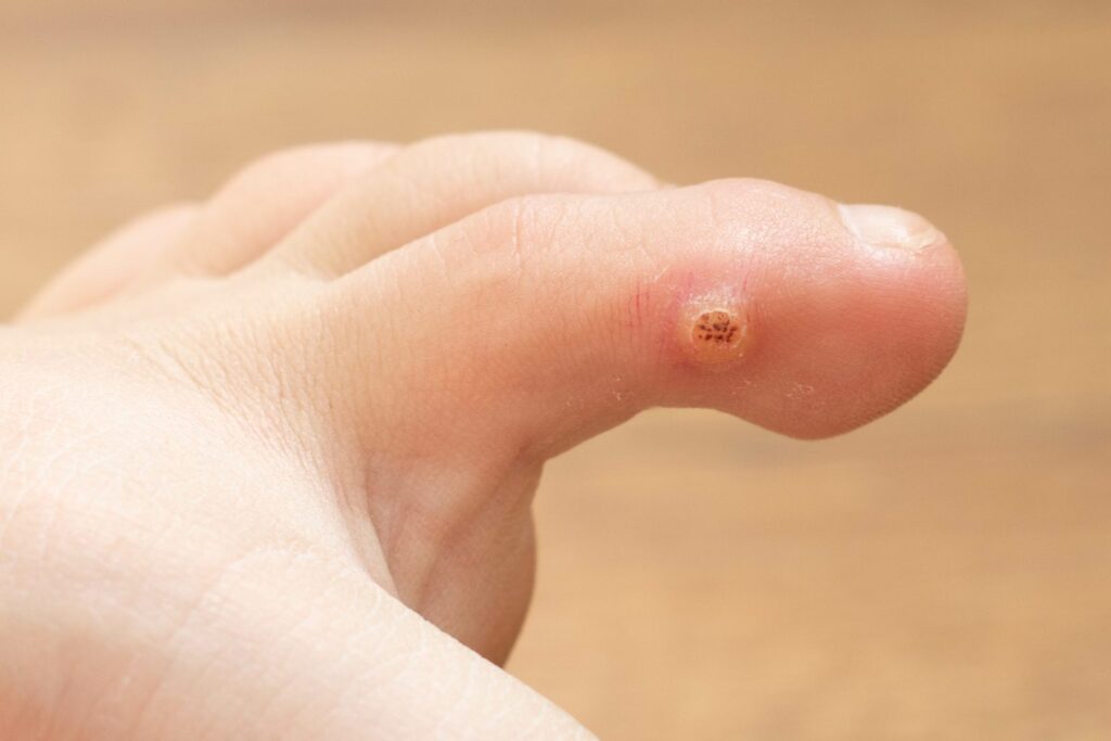 plantarna bradavica