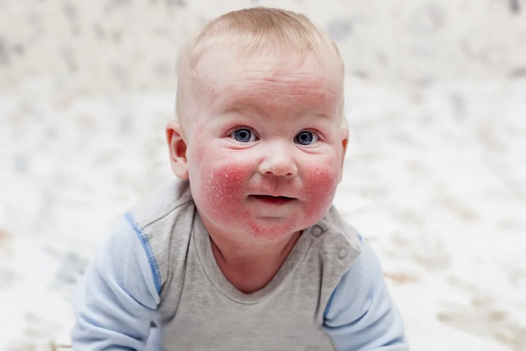 Dermatitis Pri otrocih