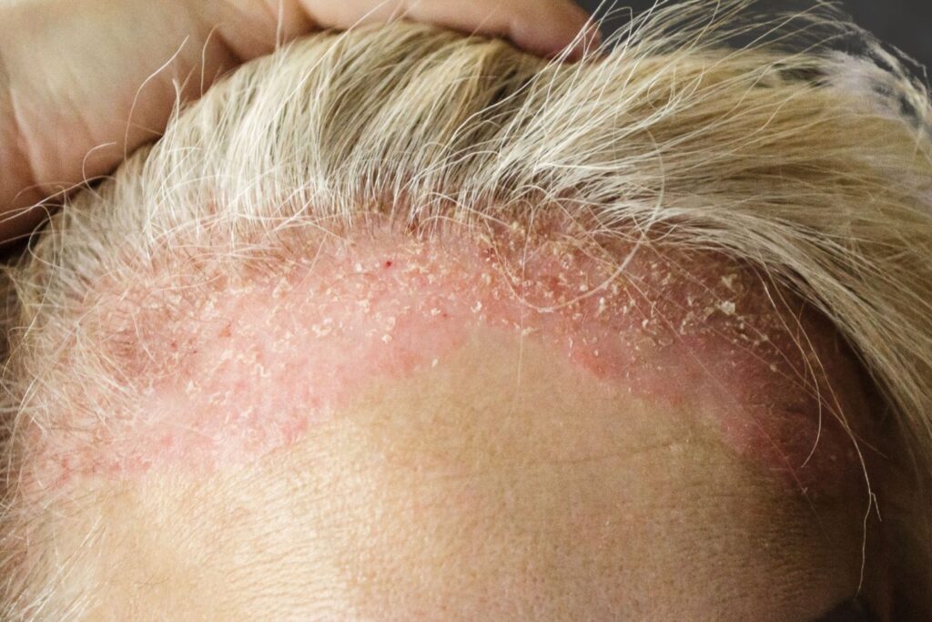 Seboroični dermatitis