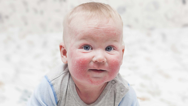 atopijski dermatitis